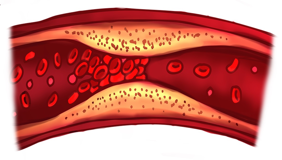 Thrombose